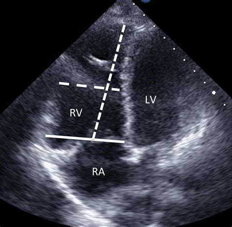 dilated right ventricle